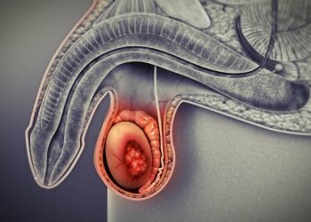 هرآنچه باید از سرطان بيضه بدانید / سرطان بیضه و علائمش 1