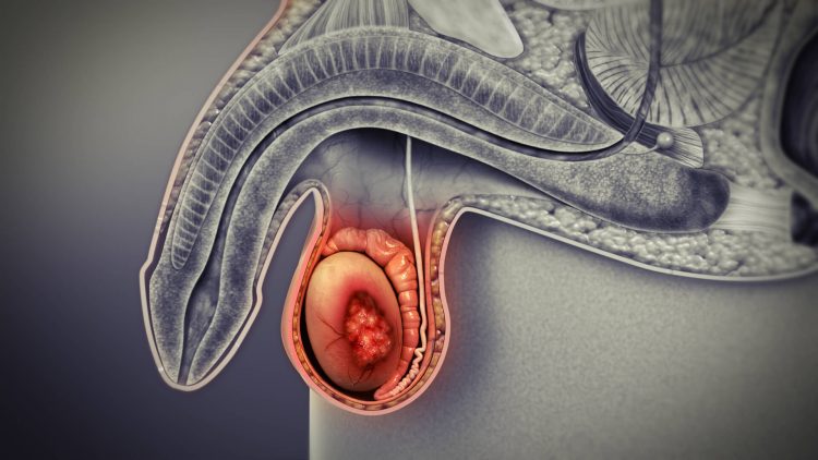 هرآنچه باید از سرطان بيضه بدانید / سرطان بیضه و علائمش 1
