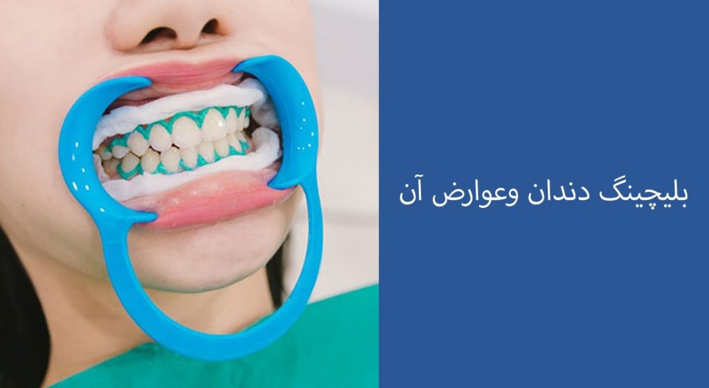 بلیچینگ دندان وعوارض آن