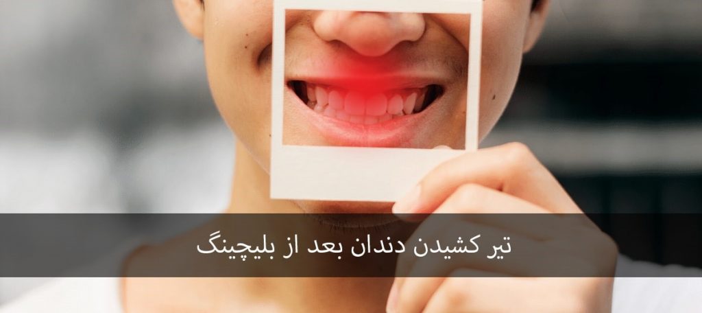 تیر کشیدن دندان بعد از بلیچینگ