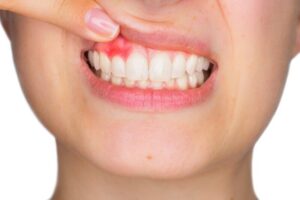 عفونت لثه (علائم، دلایل و روشهای درمان)