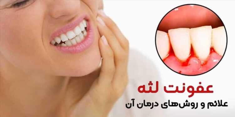 عفونت لثه (علائم، دلایل و روشهای درمان)