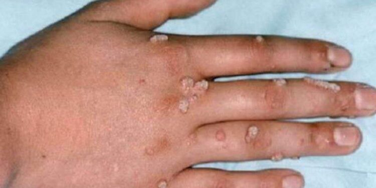 آبله میمونی چیست و چه علائمی دارد؟