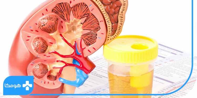 تشخیص نارسایی کلیوی با آزمایش وزن مخصوص ادرار