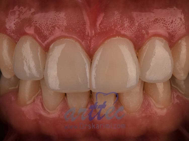 پر کردن دندان با مواد کامپوزیتی