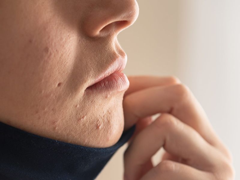 عوارض زدن ماسک چیست؟