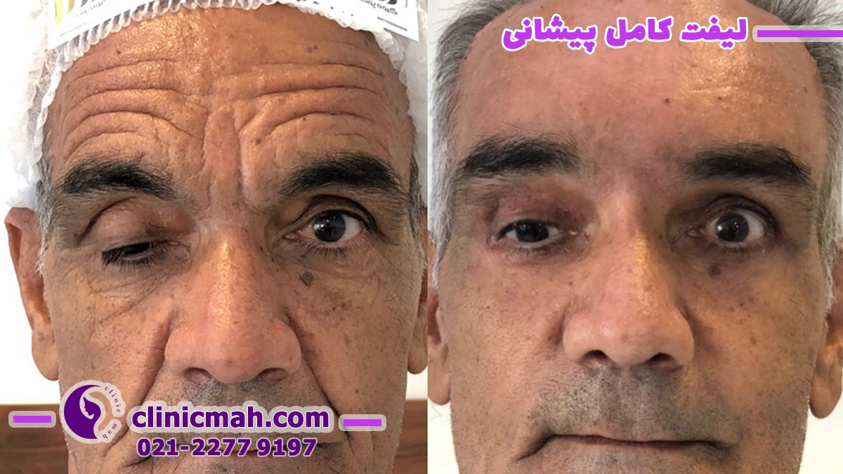لیفت شقیقه و تزریق چربی باسن و تاثیر آنها بر جوانسازی افراد