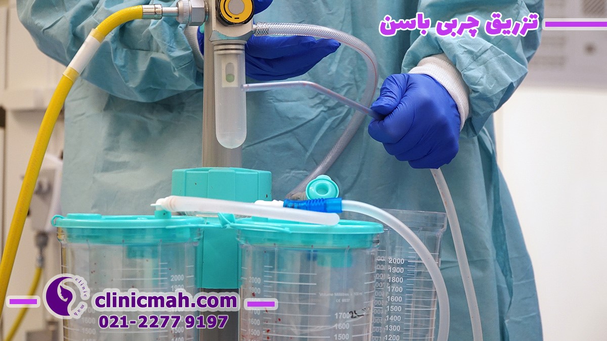 لیفت شقیقه و تزریق چربی باسن و تاثیر آنها بر جوانسازی افراد