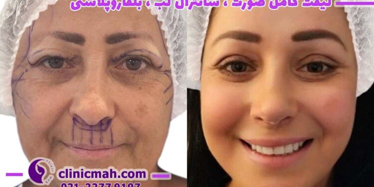 لیفت شقیقه و تزریق چربی باسن و تاثیر آنها بر جوانسازی افراد