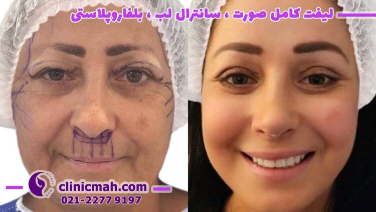 لیفت شقیقه و تزریق چربی باسن و تاثیر آنها بر جوانسازی افراد