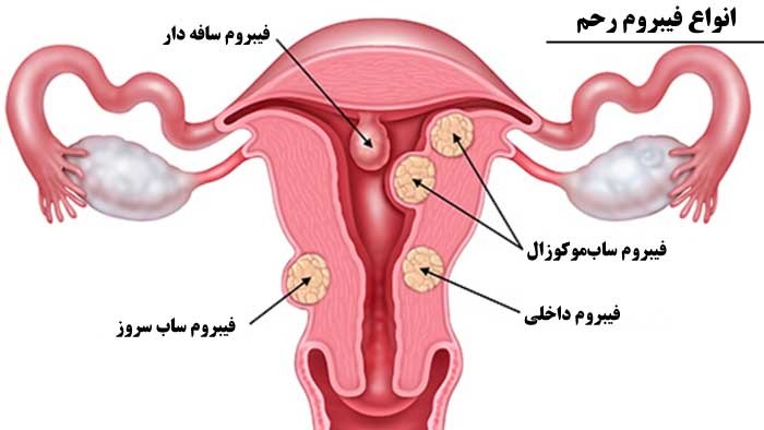 فیبروم رحمی چیست؟ برای رفع عارضه فیبروم رحم چه باید کرد؟