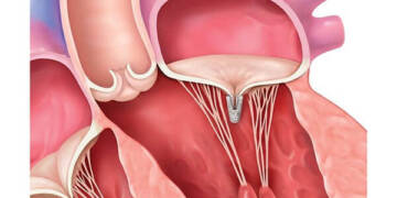 گشاد شدن دریچه ها قلب چه علائم و عوارضی دارد ؟