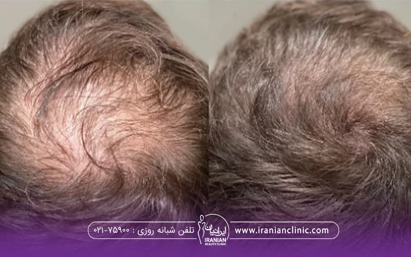 عکس قبل و بعد فردی که پی ار پی انجام داده است