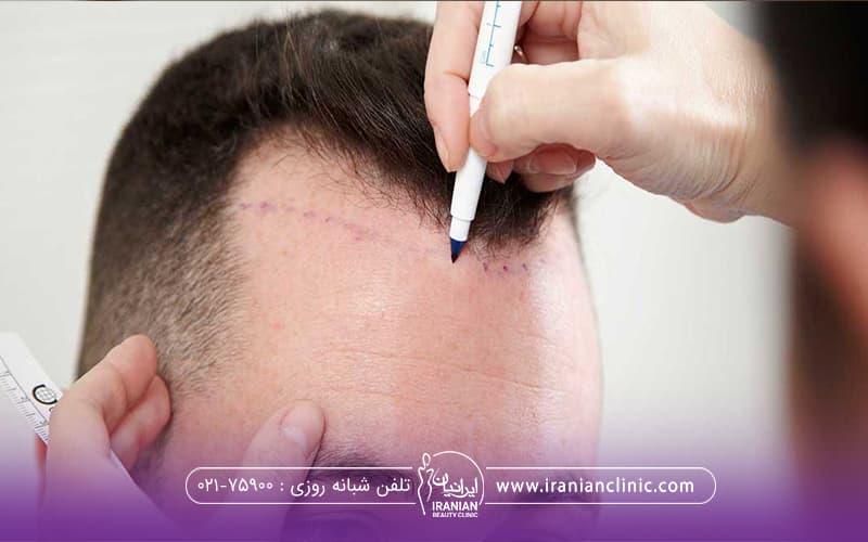 فردی که نشسته و دستان دکتری که در حال علامت زدن برای پی ار پی میباشد