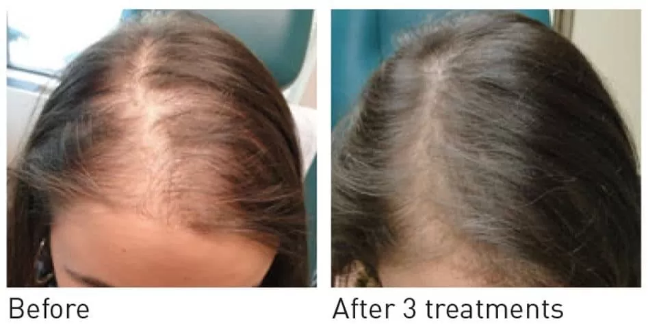آیا پی آر پی می تواند به درمان ریزش مو کمک کند؟