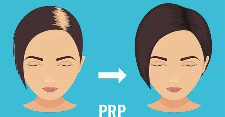آیا پی آر پی می تواند به درمان ریزش مو کمک کند؟