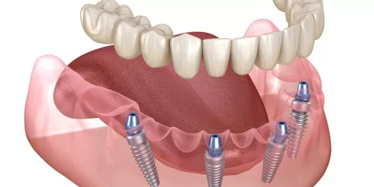 آیا گزگز ایمپلنت دندان خطرناک است؟ ( + علت و درمان )
